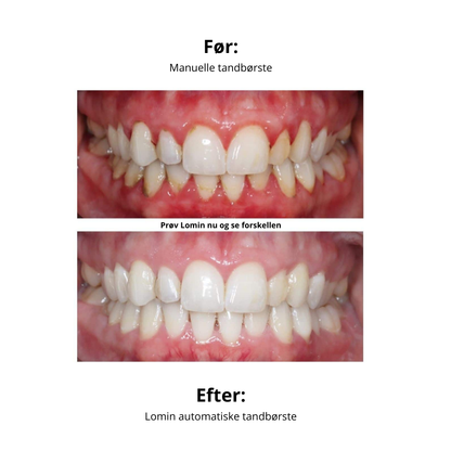 Lomin Automatiske Tandbørste